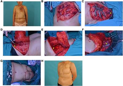 Reconstruction of chronic radiation-induced ulcers in the chest wall using free and pedicle flaps